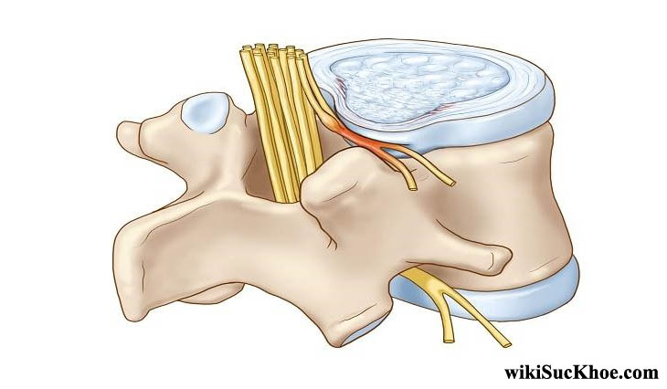 Tìm hiểu căn bệnh thoát vị đĩa điệm